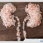 12 راهکار درمان سنگ کلیه در طب سنتی