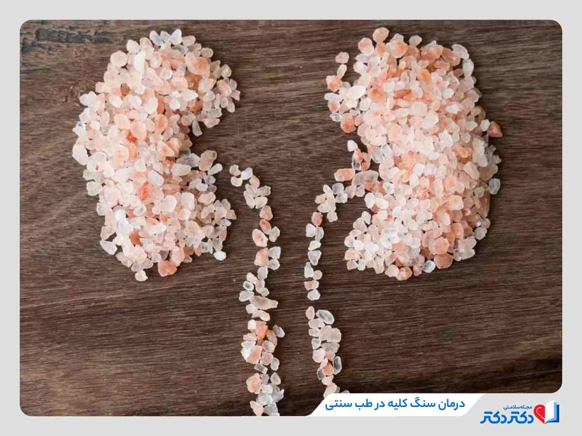 انواع روش‌های درمان سنگ کلیه با طب سنتی