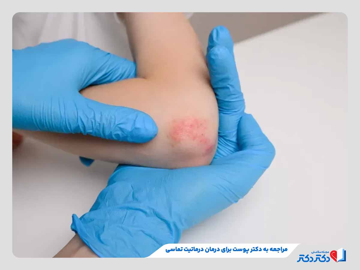دکتر پوست در حال معاینه فرد برای تشخیص درماتیت تماسی
