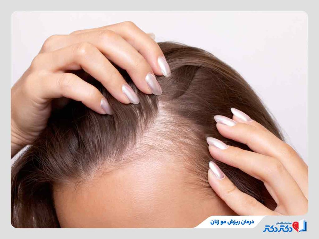 شیوه‌های درمان ریزش مو زنان