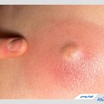 کورک پوستی یا دمل چیست و چگونه فوری درمان می‌شود؟