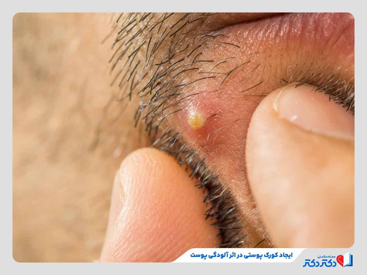 فرد مبتلا به کورک پوستی در اثر عدم رعایت بهداشت پوست