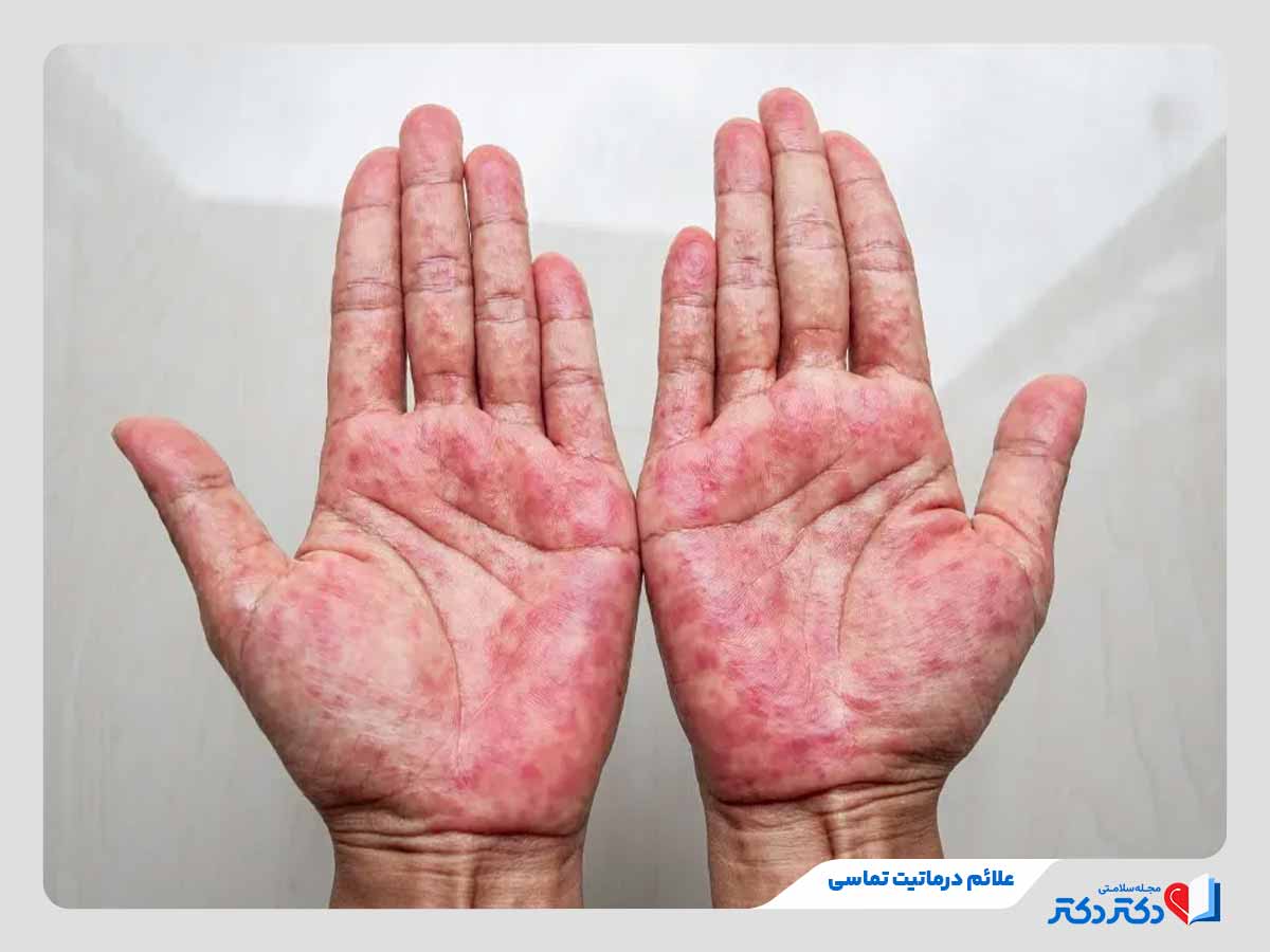فرد مبتلا به قرمزی، تورم و خارش کف دست در اثر درماتیت تماسی