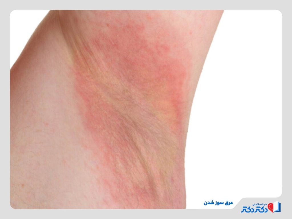 عرق سوز شدن در ناحیه زیر بغل