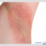 عرق سوز شدن؛ 5 دلیل مهم عرق سوز و راه‌های درمان فوری آن