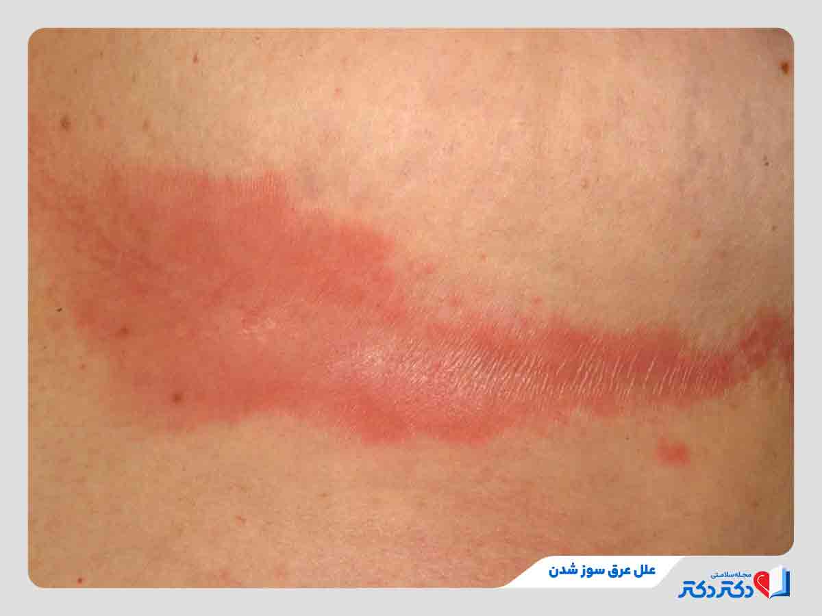 عرق سوز شدن در ناحیه زیر سینه
