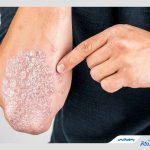 پسوریازیس؛ از علائم تا جدیدترین روش‌های درمان