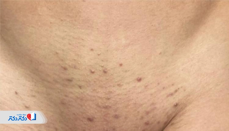 جوش واژن ناشی از اصلاح موهای ناحیه تناسلی