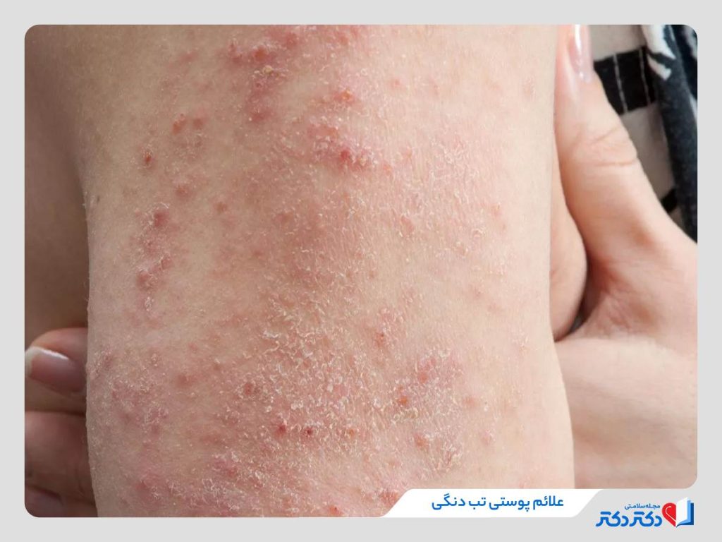 علائم تب دنگی از حفیف تا شدید + راه‌های پیشگیری
