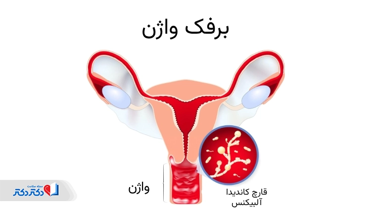 برفک واژن