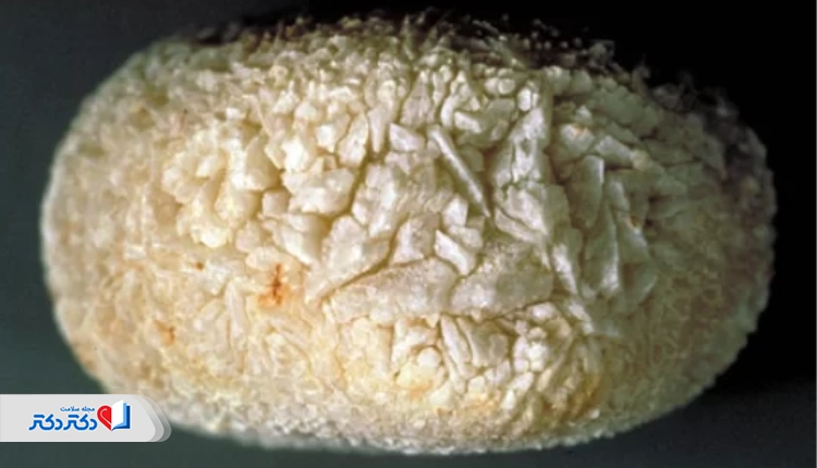 سنگ کلیه اسیداوریک