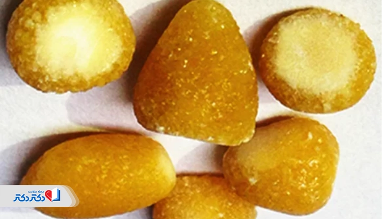 سنگ کلیه سیستئین
