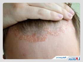 اگزمای پوست سر؛ علل، نشانهها و بهترین راهکارهای کنترل بیماری