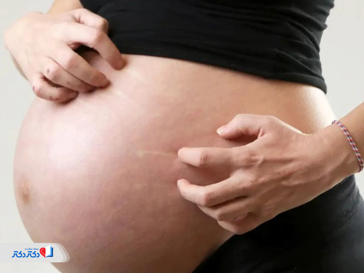 کلستاز بارداری از اختلالات پوستی در بارداری
