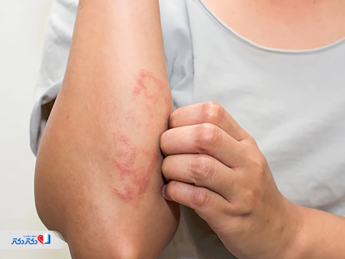 قطع مصرف قرص لاغری دابل کات درصورت واکنش آلرژیک
