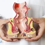 بواسیر چیست؟ علل، علائم، روش‌های درمان و پیشگیری