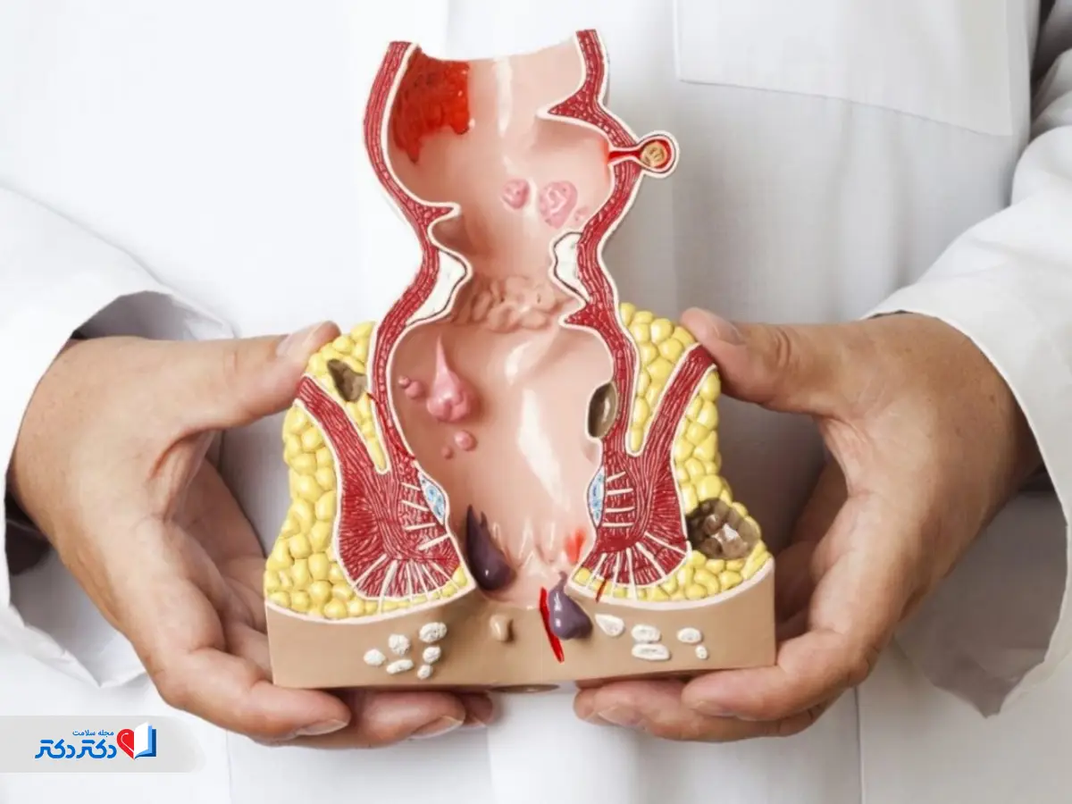 بواسیر در ماکت بخش انتهایی دستگاه گوارش