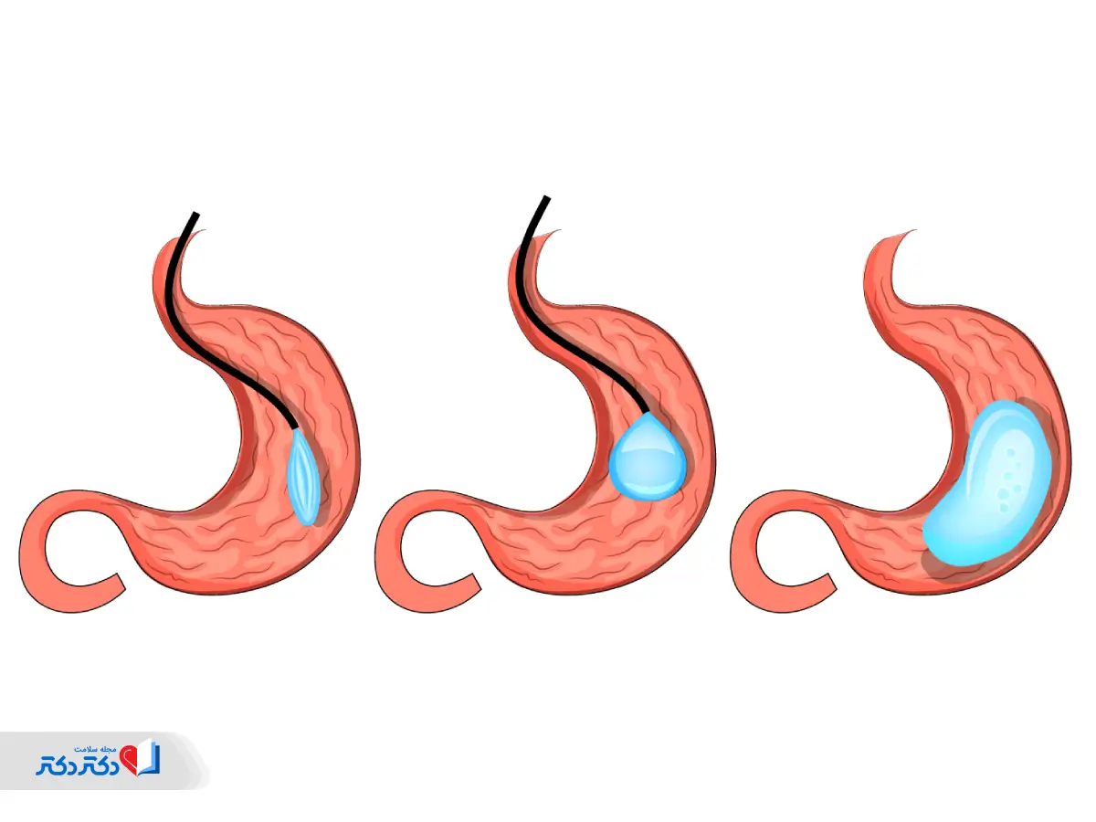 روش جایگذاری بالن معده