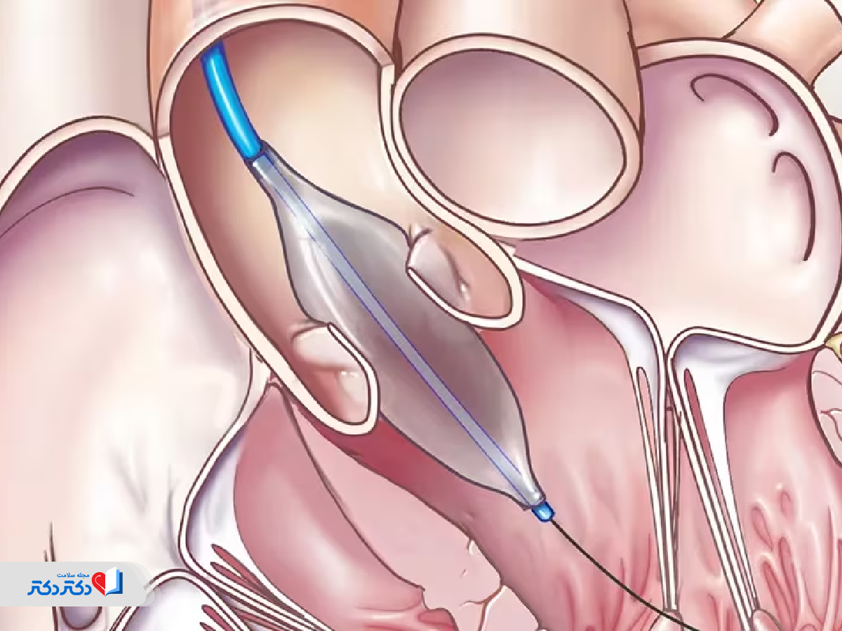 گشادکردن دریچه میترال توسط بالون برای درمان روماتیسم قلبی