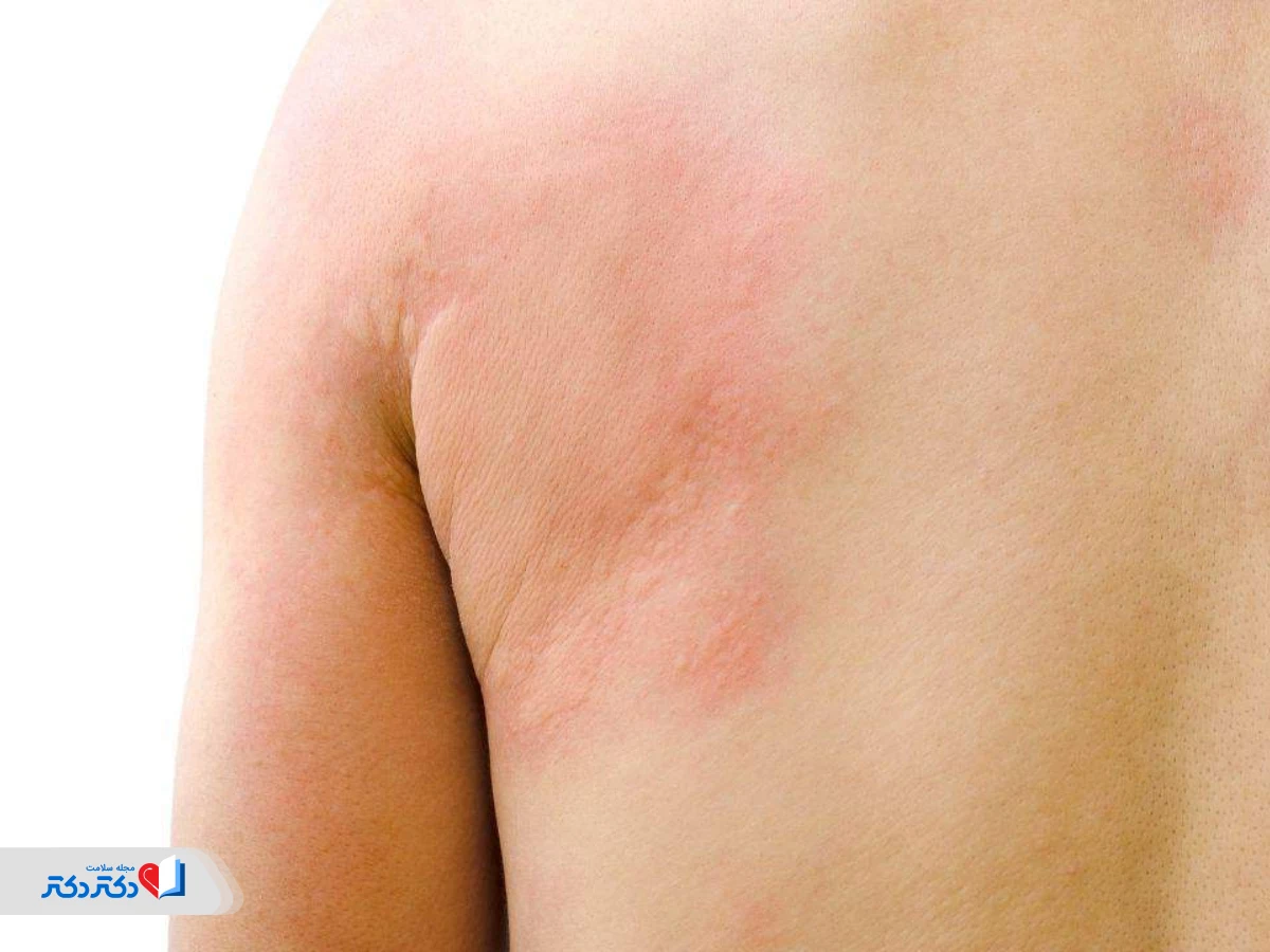 صورة الشرى العصبي