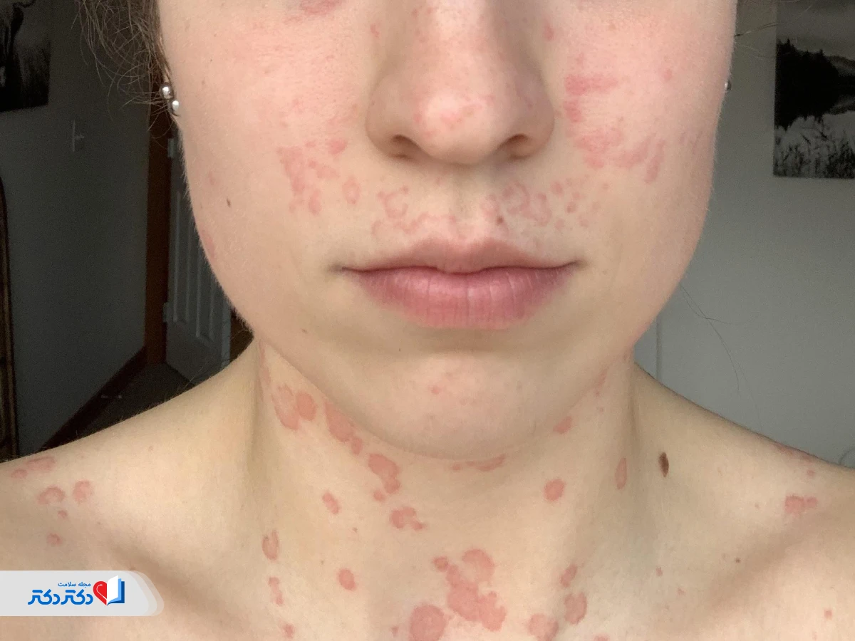 ما هو شرى الوجه