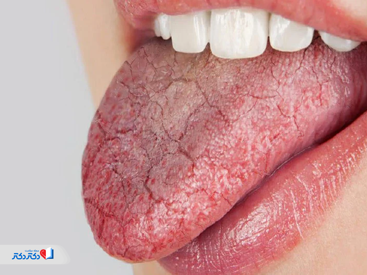 خشکی دهان از عوارض آمپول‌های لاغری