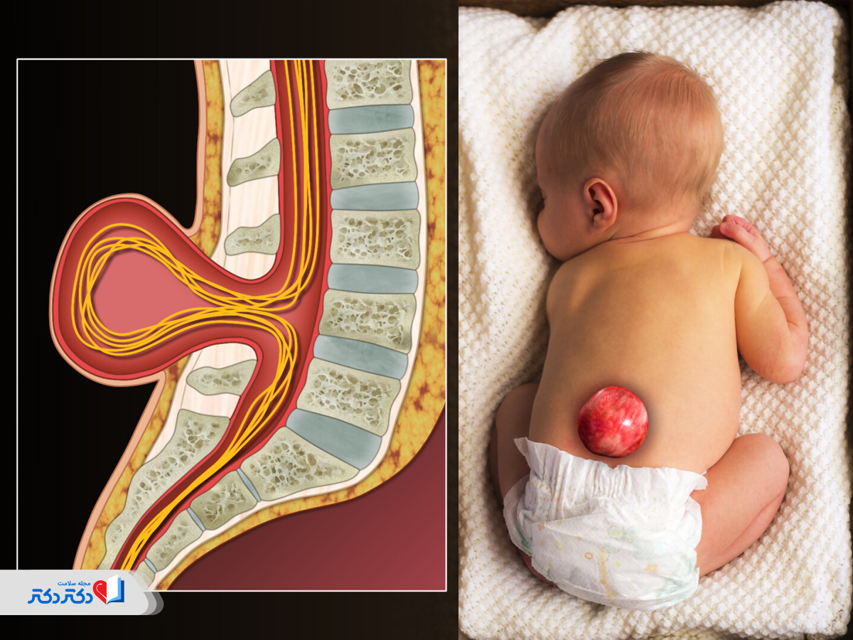 تشخیص اختلالات اسکلتی جنین در آنومالی
