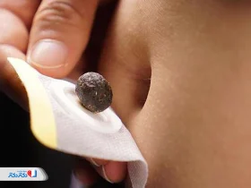 قرص ناف لاغری و تأثیر آن در کاهش وزن