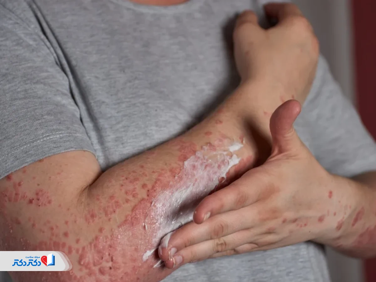 علاج الشرى العصبي