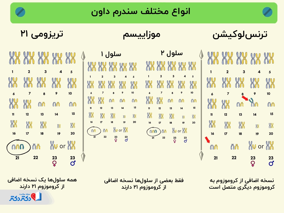 انواع سندرم داون