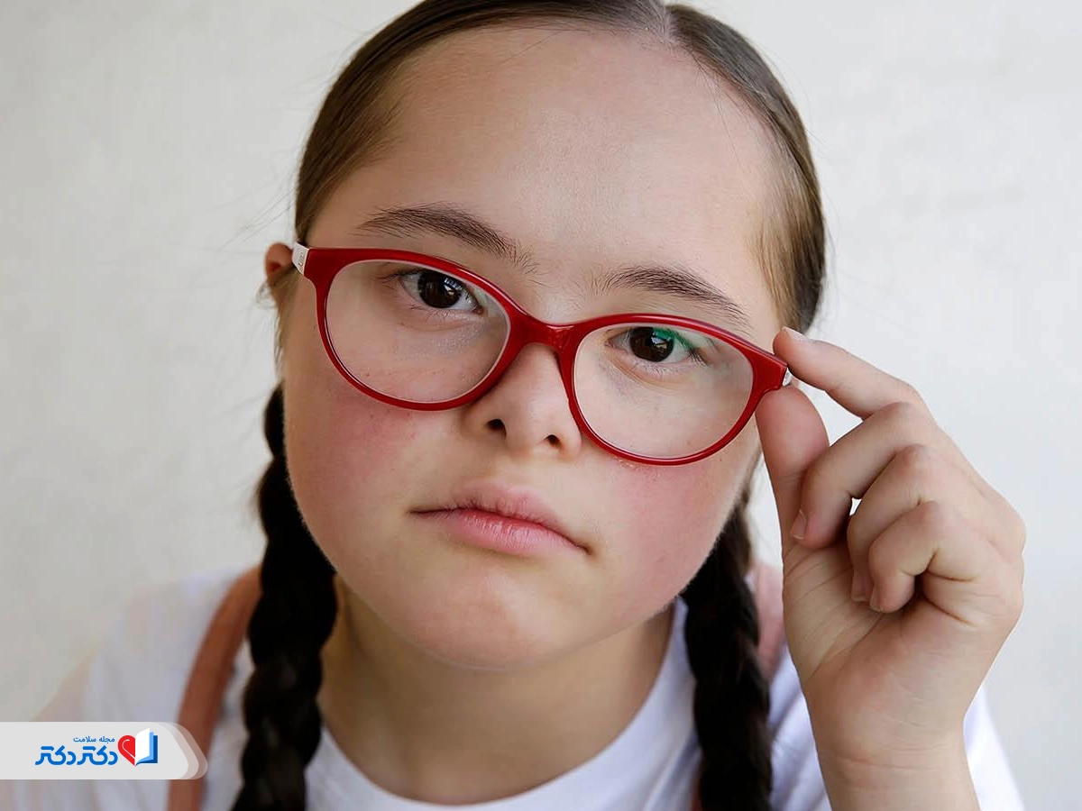 سندرم داون خفیف