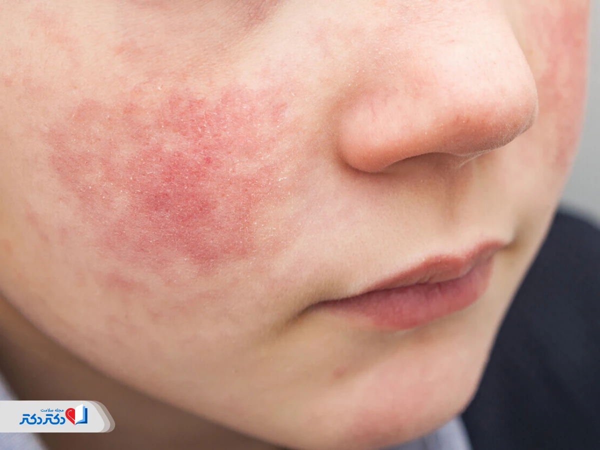 پماد و کرم اگزمای صورت