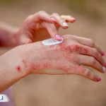 پمادهای موثر برای اگزمای پوستی: راهنمای انتخاب و قیمت