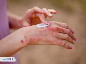 پمادهای موثر برای اگزمای پوستی: راهنمای انتخاب و قیمت