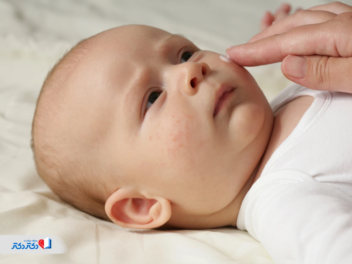 بهترین پماد برای اگزمای صورت نوزاد و کودک
