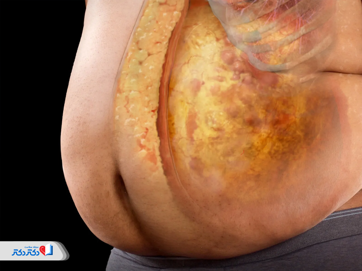 انسولین، هورمون محرک چاقی و انباشت چربی