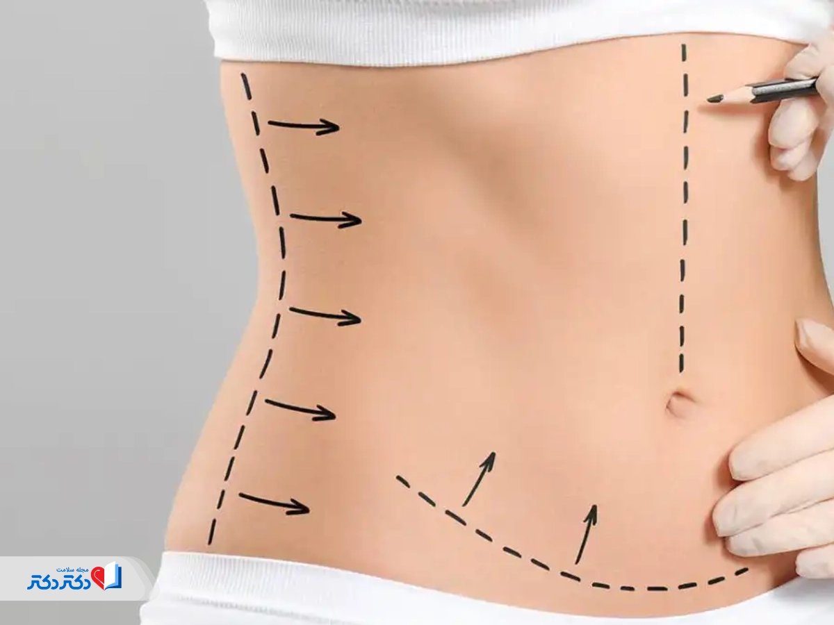 عمل لیپوماتیک چیست؟