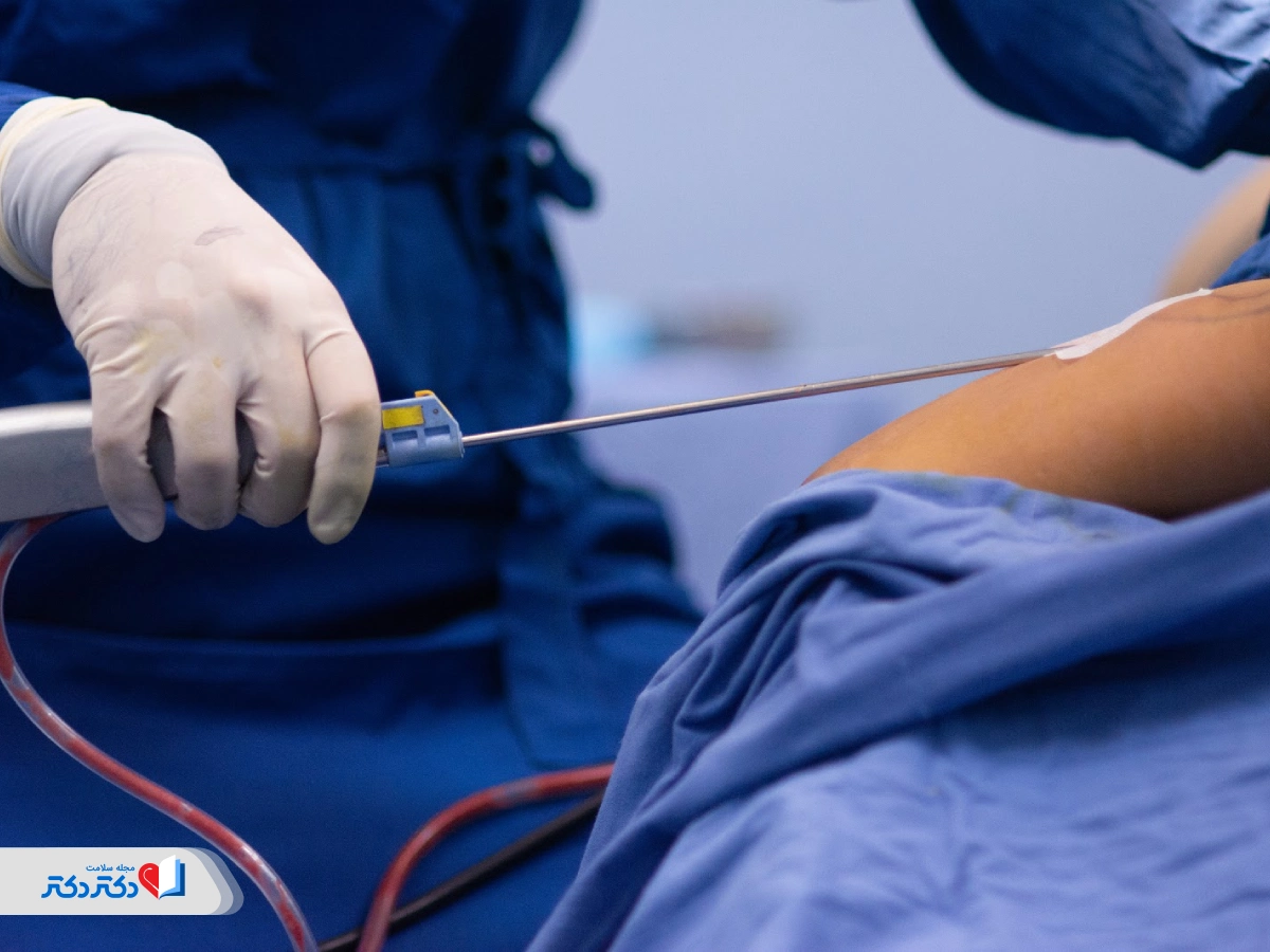 عمل لیپوماتیک چگونه انجام می‌شود؟