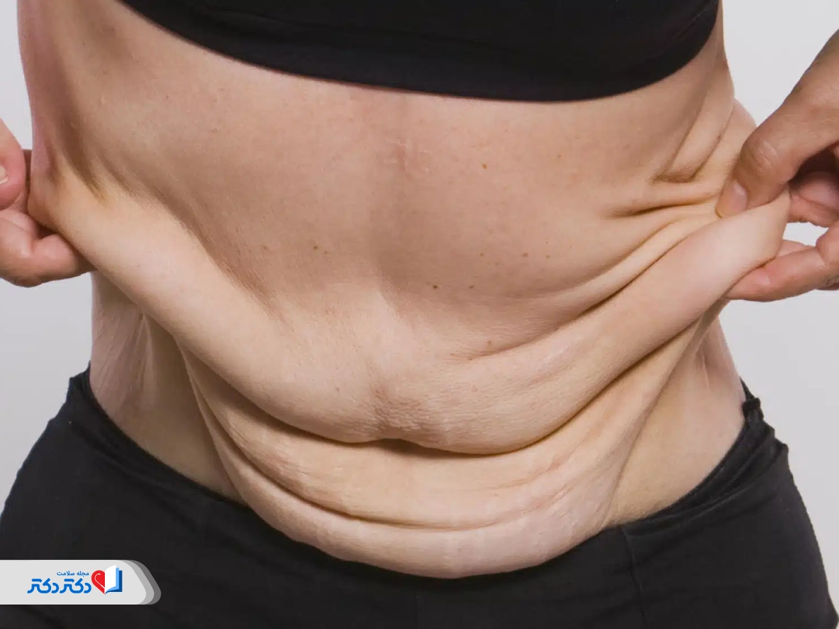 عمل لیپوماتیک برای افراد بسیار چاق مناسب نیست.
