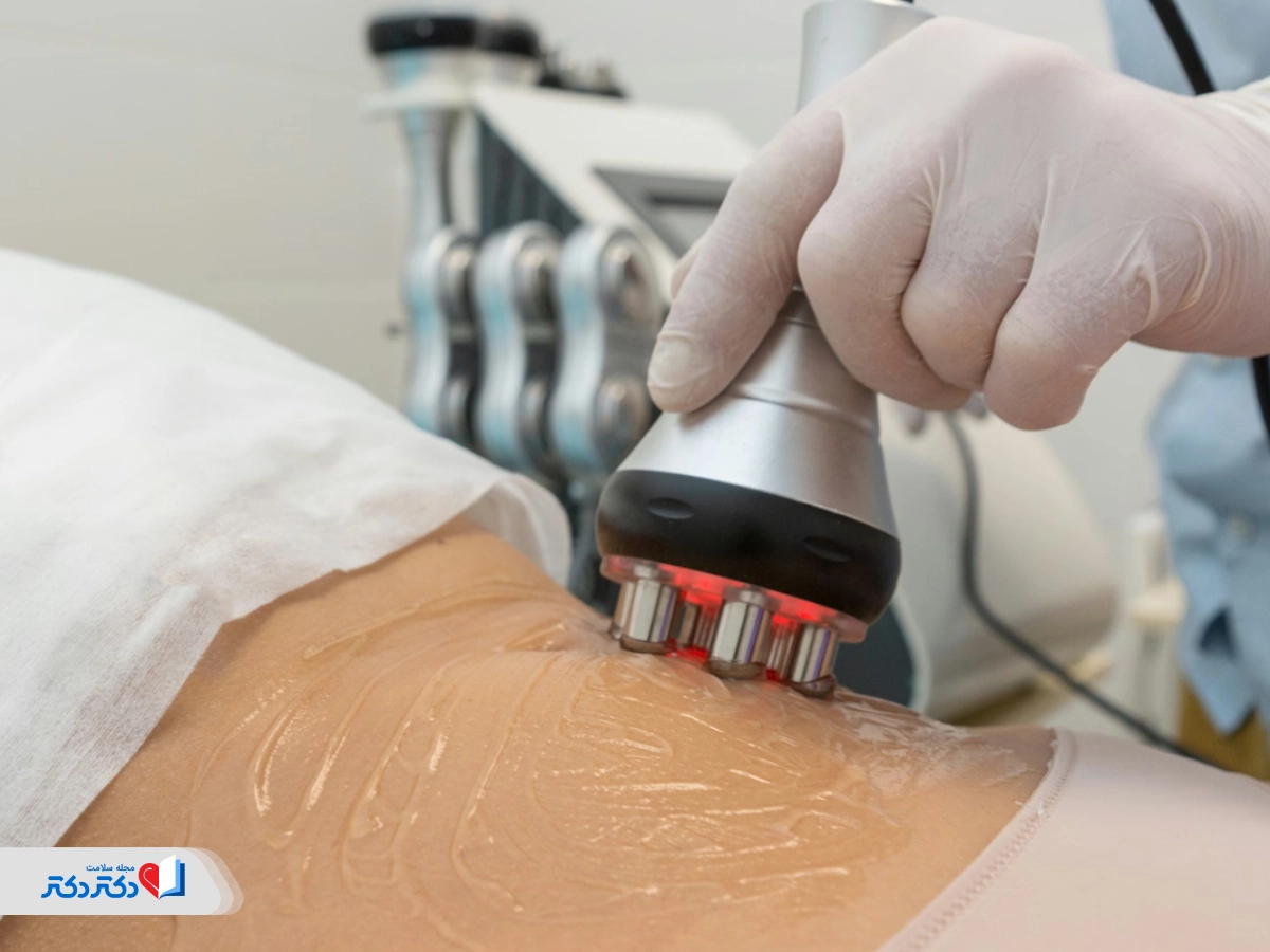 آر اف و کویتیشن بعد از لیپوماتیک