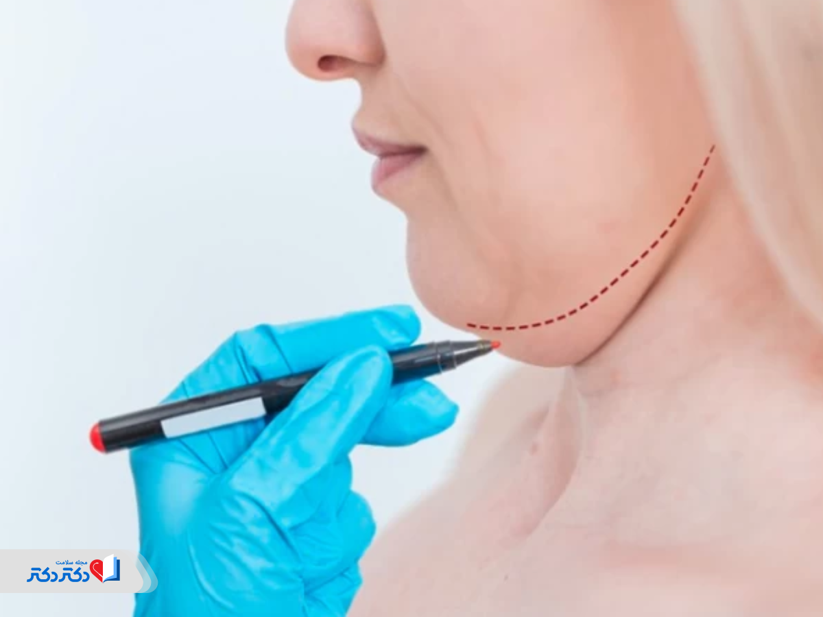 عمل لیپوماتیک غبغب