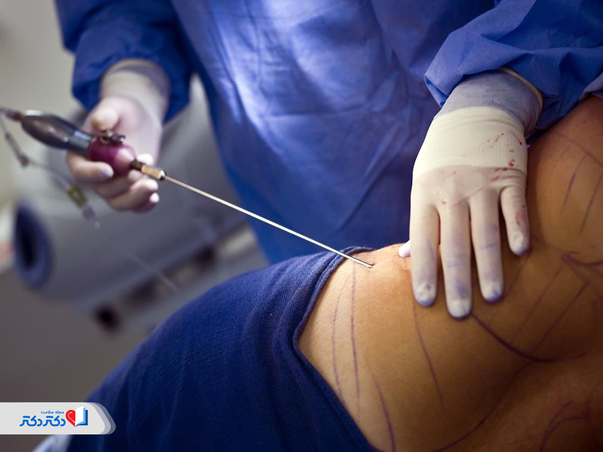 همه‌چیز درباره لیپوساکشن؛ عمل جراحی تخلیه چربی