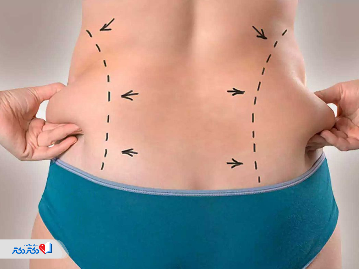 عمل جراحی لیپوساکشن