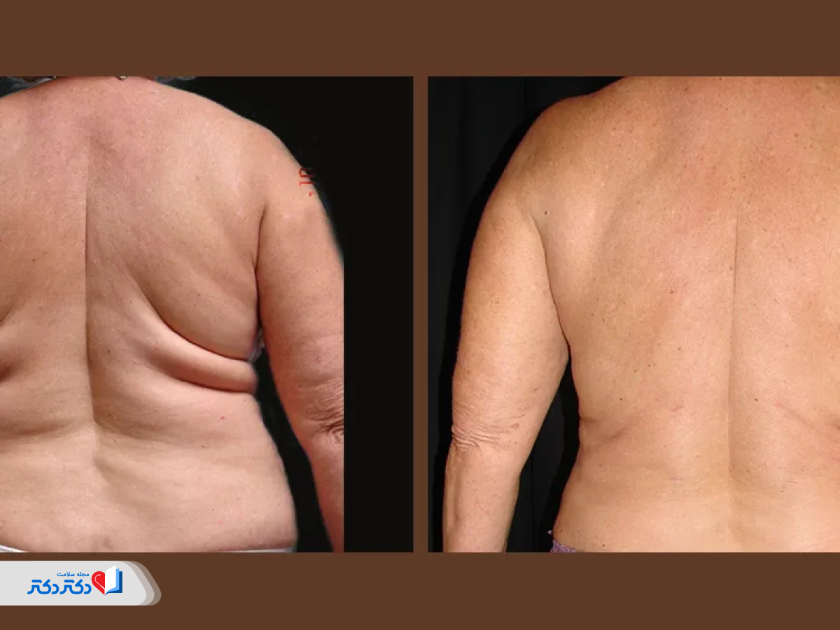 لیپوساکشن کمر و پشت
