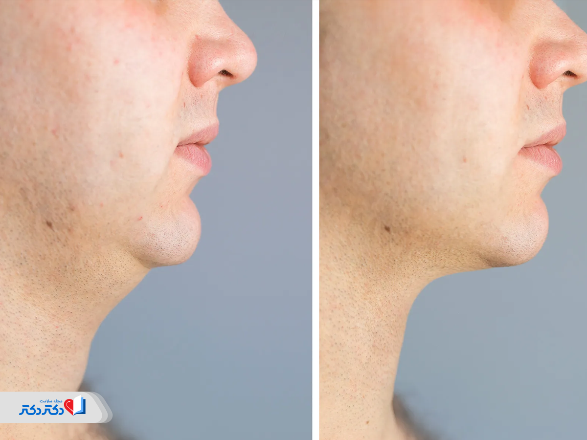 لیپوساکشن گردن و غبغب