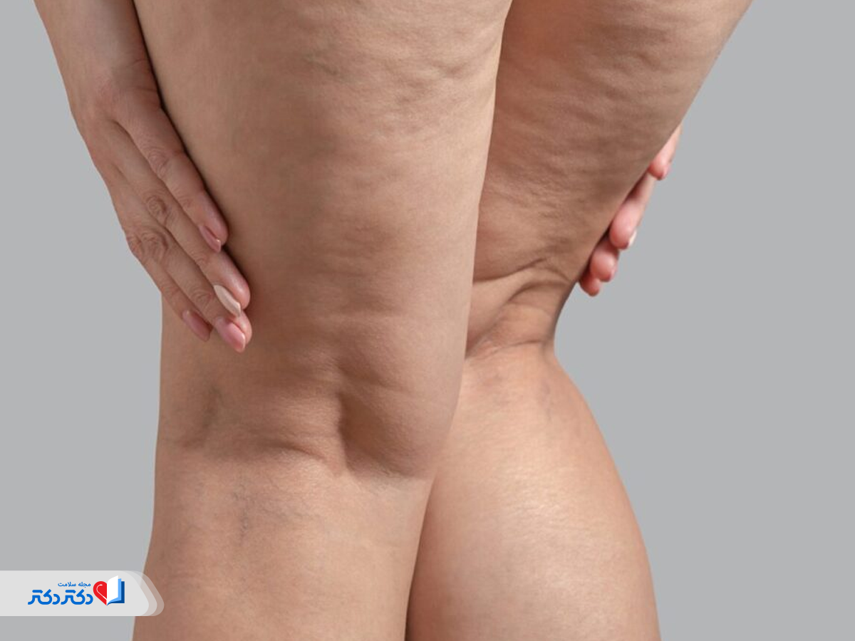 کاربرد لیپوساکشن برای حذف چربی لیپیدما 