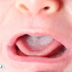 برفک دهان نوزاد چیست؟ علت، علائم و راه های درمانی