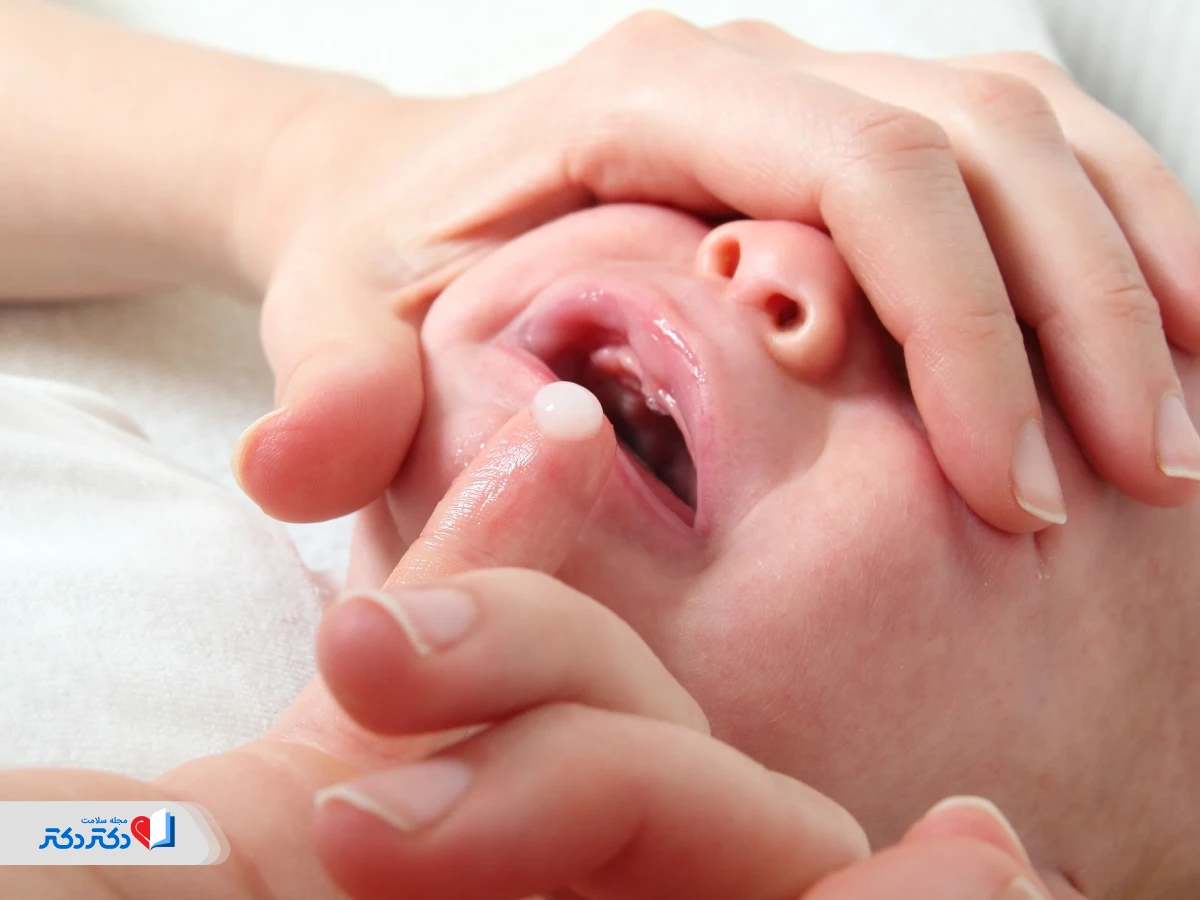 درمان برفک دهان نوزاد