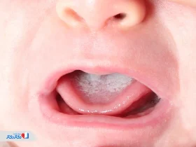 برفک دهان نوزاد چیست؟ علت، علائم و راه های درمانی