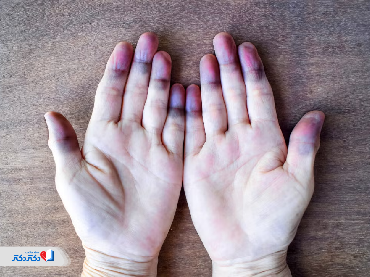 روشهای تشخیص دلیل عرق کف دست